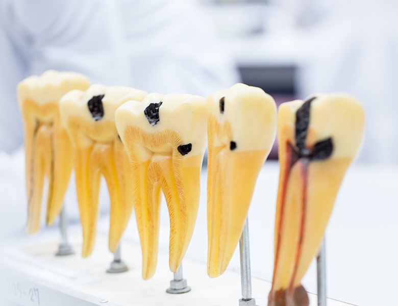  八千代緑が丘駅より徒歩1分の歯医者、公園都市プラザわかば歯科のむし歯治療