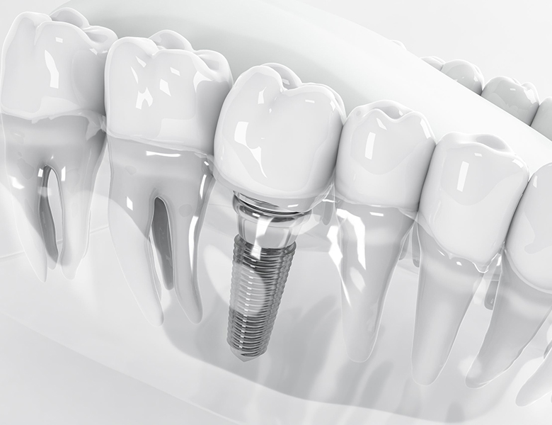 金沢文庫（横浜市金沢区）の歯医者、桜井歯科医院のインプラント治療