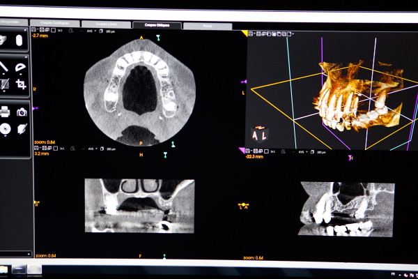 八千代緑が丘駅より徒歩1分の歯医者、公園都市プラザわかば歯科のマイクロスコープ精密治療