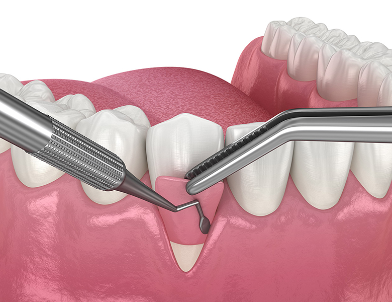金沢文庫（横浜市金沢区）の歯医者、桜井歯科医院の歯周病治療