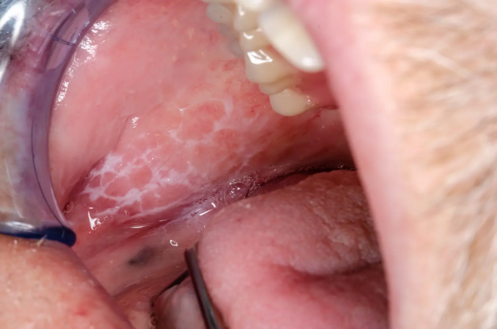 金沢文庫（横浜市金沢区）の歯医者、桜井歯科医院のお口の中のデキモノ