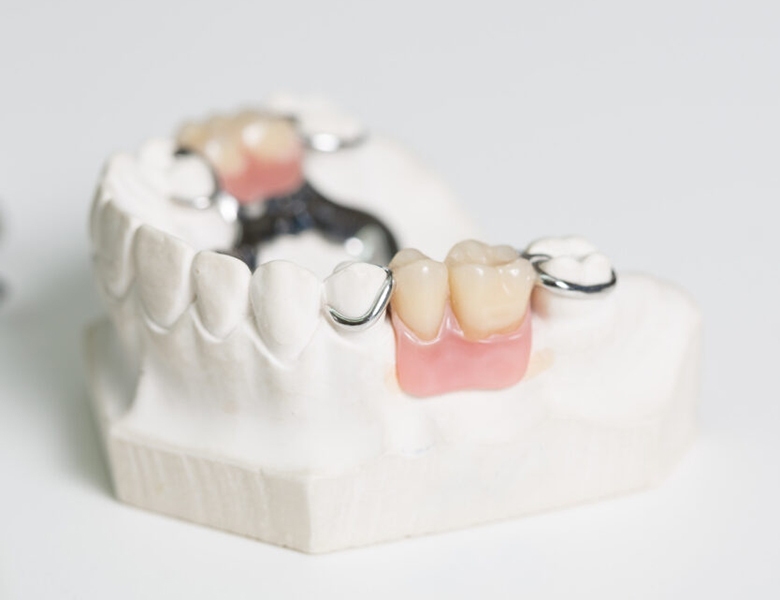 金沢文庫（横浜市金沢区）の歯医者、桜井歯科医院の入れ歯治療