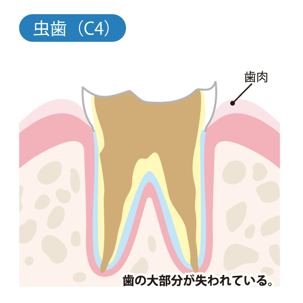  八千代緑が丘駅より徒歩1分の歯医者、公園都市プラザわかば歯科のなるべく削らず、歯を守る治療