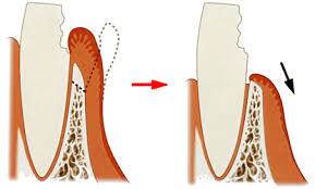 金沢文庫（横浜市金沢区）の歯医者、桜井歯科医院のむし歯治療