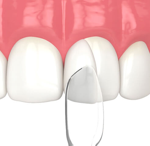 八千代緑が丘駅より徒歩1分の歯医者、公園都市プラザわかば歯科の審美歯科治療