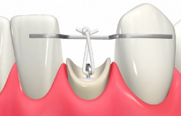 金沢文庫（横浜市金沢区）の歯医者、桜井歯科医院のむし歯治療