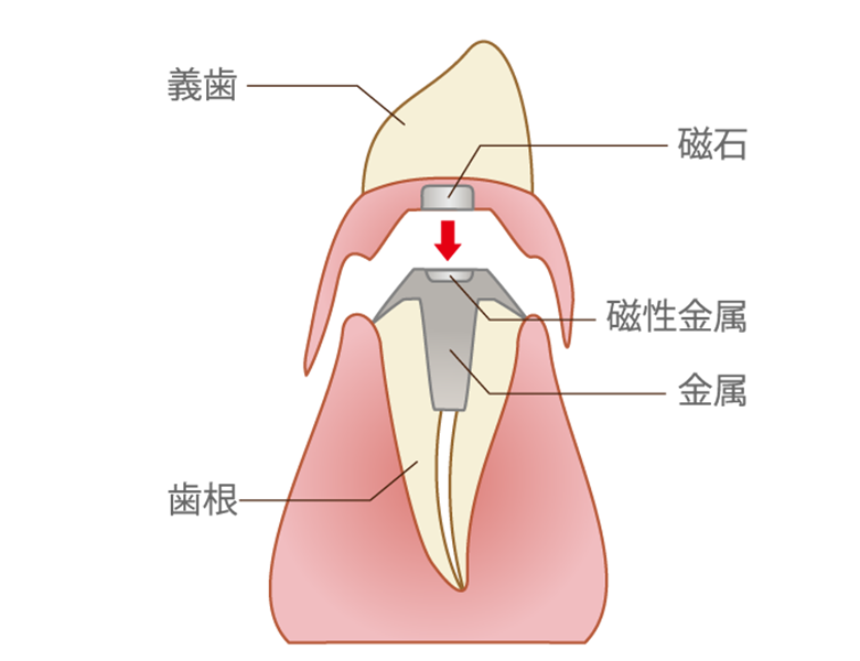 金沢文庫（横浜市金沢区）の歯医者、桜井歯科医院の入れ歯治療