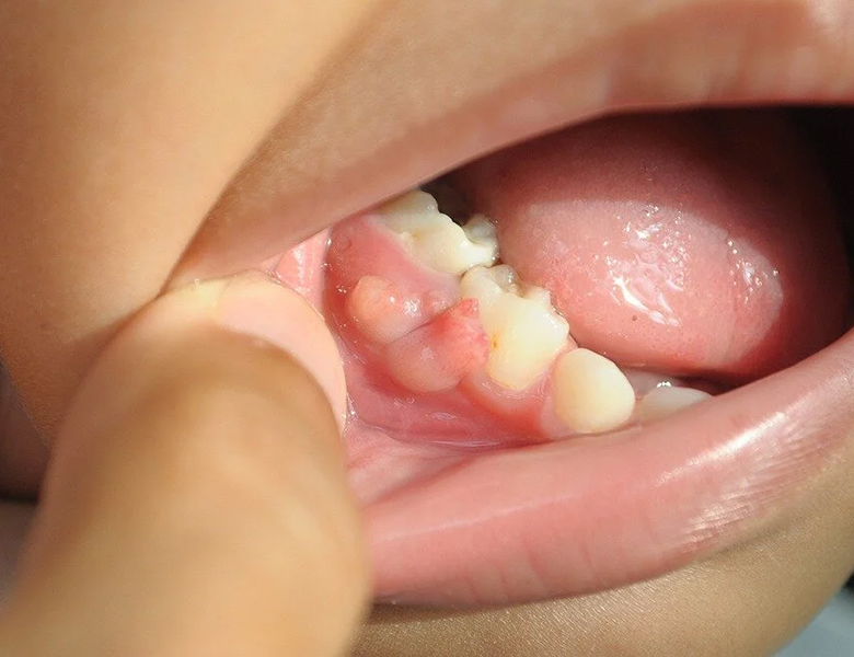 金沢文庫（横浜市金沢区）の歯医者、桜井歯科医院のお口の中のデキモノ