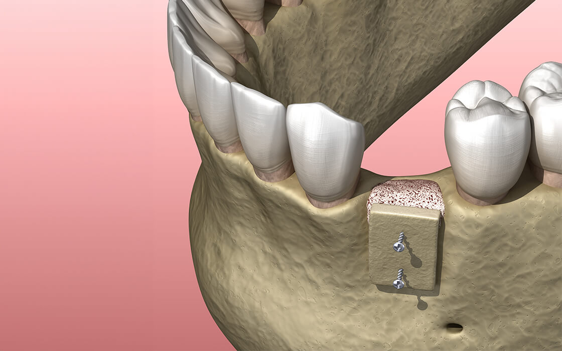 八千代緑が丘駅より徒歩1分の歯医者、公園都市プラザわかば歯科のインプラント治療