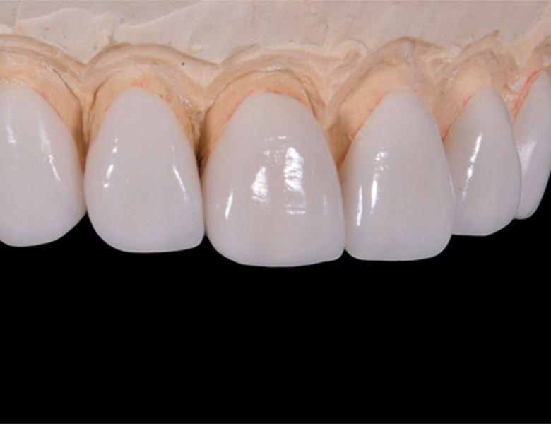 八千代緑が丘駅より徒歩1分の歯医者、公園都市プラザわかば歯科の審美歯科治療