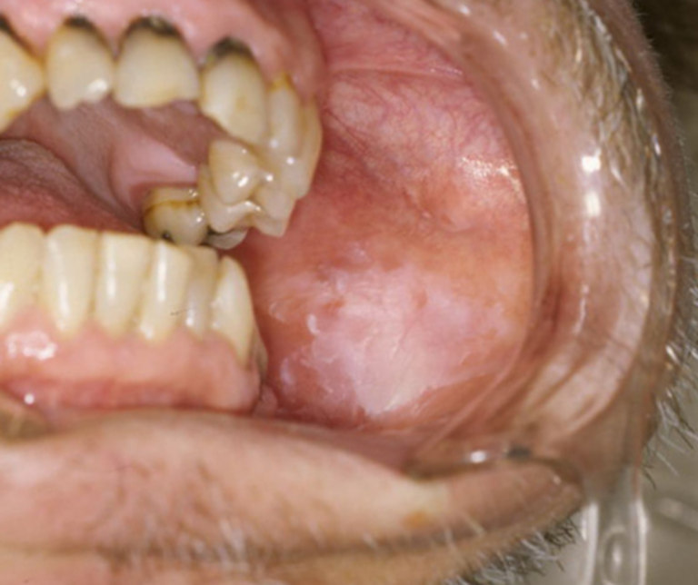 金沢文庫（横浜市金沢区）の歯医者、桜井歯科医院のお口の中のデキモノ