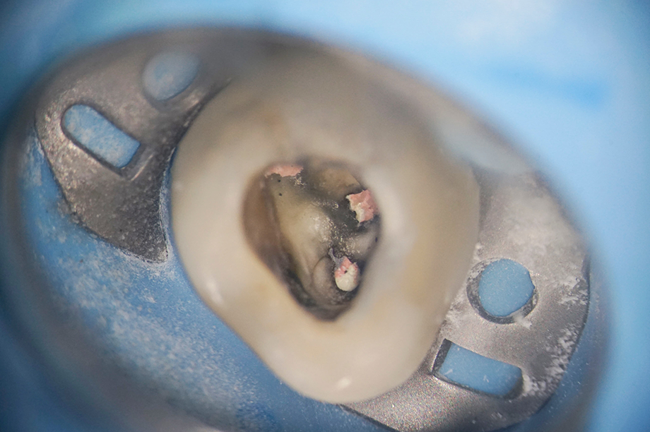 八千代緑が丘駅より徒歩1分の歯医者、公園都市プラザわかば歯科のマイクロスコープ精密治療