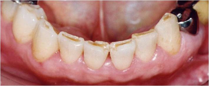 金沢文庫（横浜市金沢区）の歯医者、桜井歯科医院の歯ぎしり、食いしばり