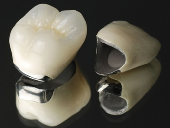 八千代緑が丘駅より徒歩1分の歯医者、公園都市プラザわかば歯科の審美歯科治療