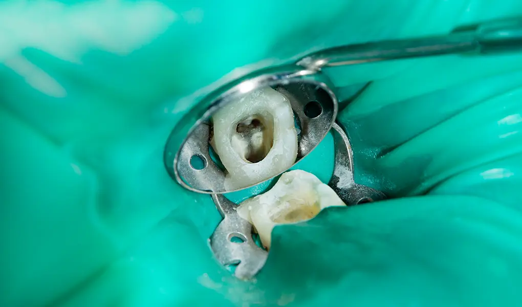 金沢文庫（横浜市金沢区）の歯医者、桜井歯科医院の精密根管治療