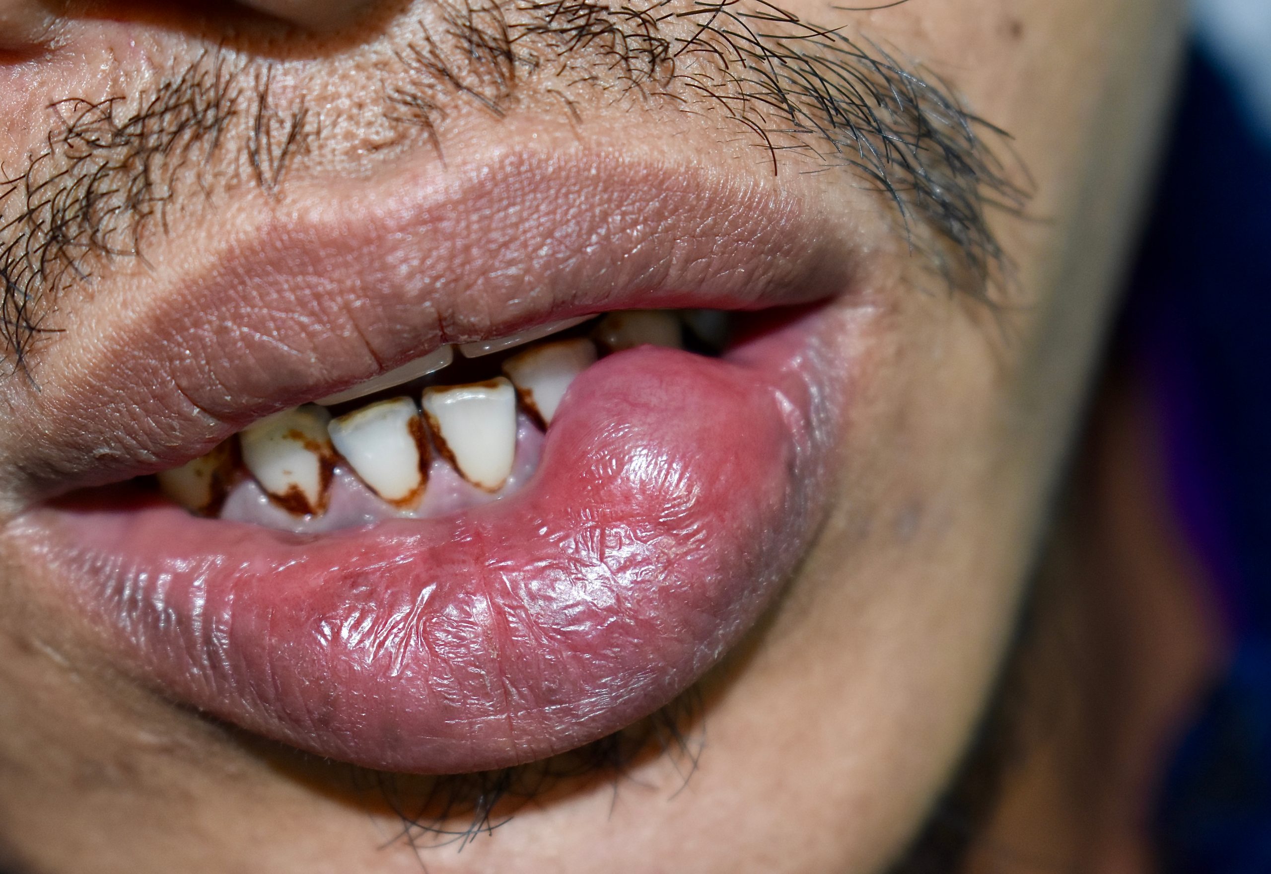 金沢文庫（横浜市金沢区）の歯医者、桜井歯科医院のお口の中のデキモノ